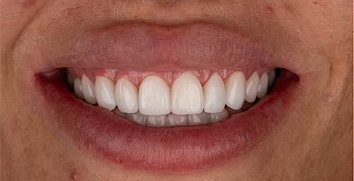 Smile Design Cheyanne Dawson After