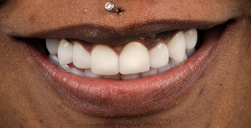 Smile Design Crystalyn Prater After