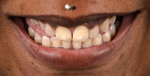 Smile Design Crystalyn Prater Before