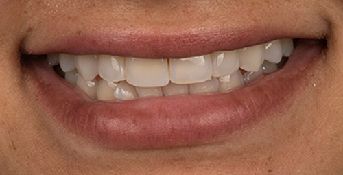 Smile Design Daniela Sequea Before