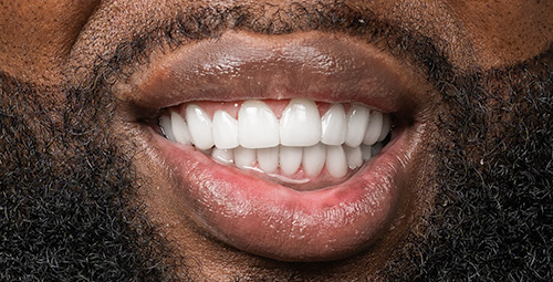 Smile Design Deshawn shipp After