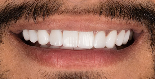 Smile Design Gurman Preet After