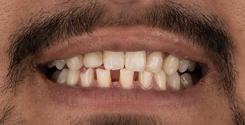 Smile Design Gurman Preet Before