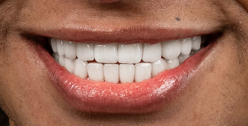 Smile Design Isaac After