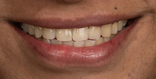 Smile Design Isaac Before