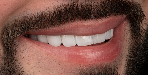 Smile Design Jean Carlos Sosa After