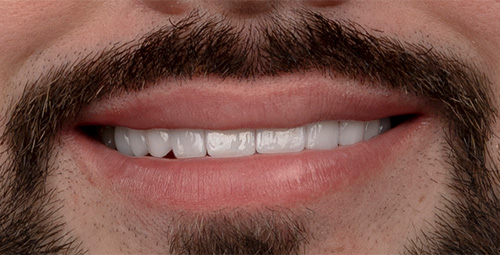 Smile Design Jean Carlos Sosa After