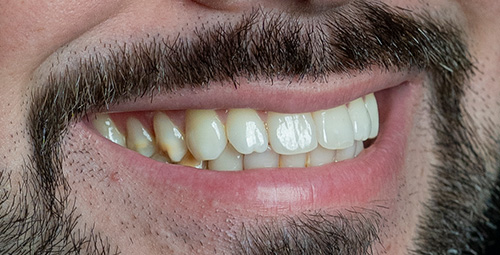 Smile Design Jean Carlos Sosa Before