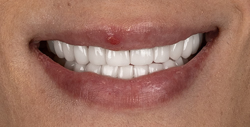 Smile Design Jessica Gomes After