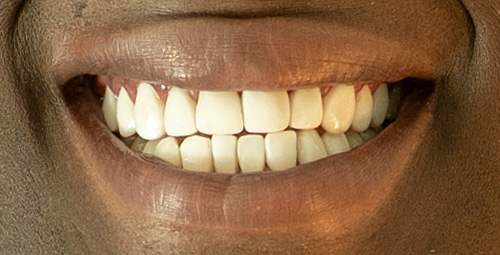 Smile Design Khay Nelson After