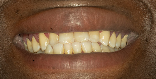 Smile Design Khay Nelson Before