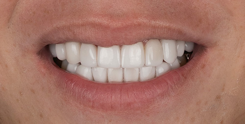 Smile Design Leonardo After