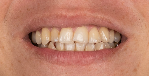 Smile Design Leonardo Before