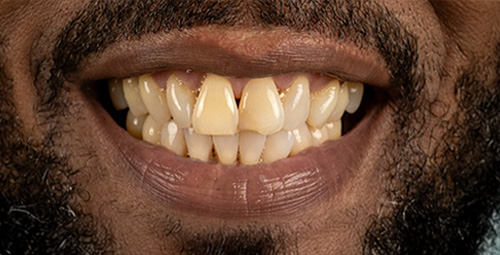 Smile Design Lotoya Manson Before