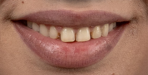 Smile Design Luz Padilla Before