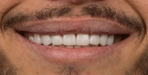 Smile Design Robison Escalona After