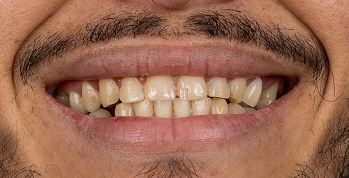 Smile Design Robison Escalona Before