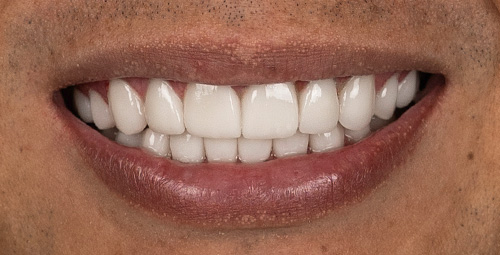 Smile Design Sergio Andres After