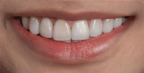 Smile Design Patient After