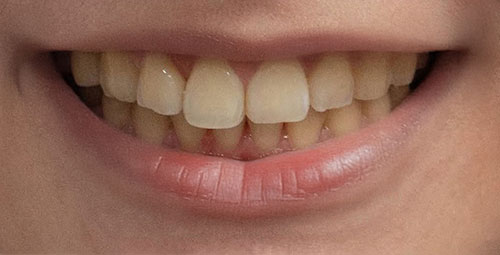 Smile Design Patient Before