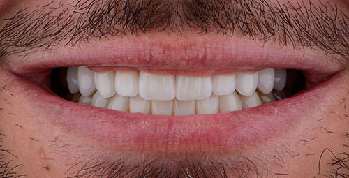 Smile Design Patient10 After