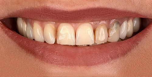 Smile Design Patient2 Before