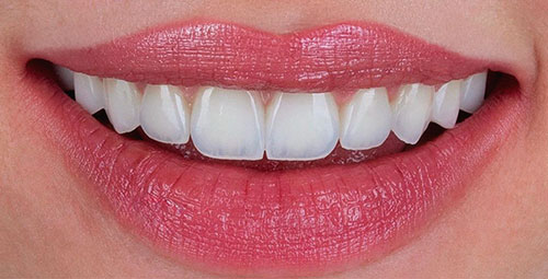 Smile Design Patient3 After