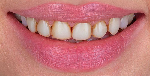 Smile Design Patient3 Before