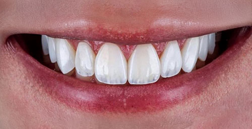 Smile Design Patient4 After