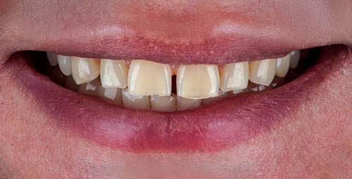 Smile Design Patient4 Before