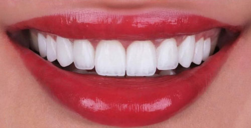 Smile Design Patient5 After