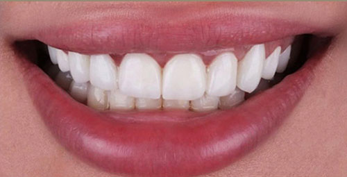 Smile Design Patient5 Before