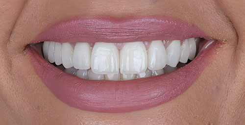 Smile Design Patient6 After