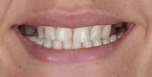 Smile Design Patient6 Before