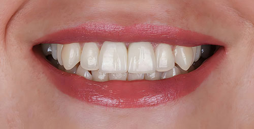 Smile Design Patient7 After