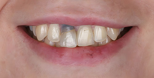 Smile Design Patient7 Before