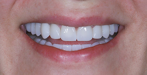 Smile Design Patient8 After