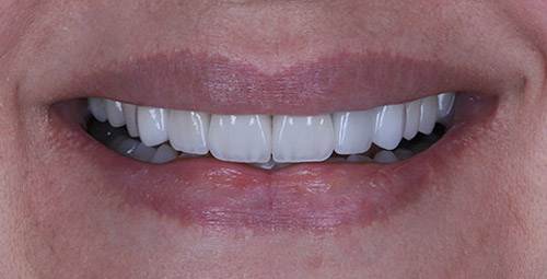 Smile Design Patient9 After