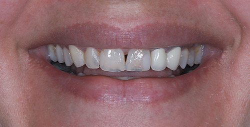 Smile Design Patient9 Before