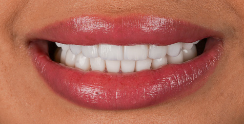 Smile Design Patient 2 After