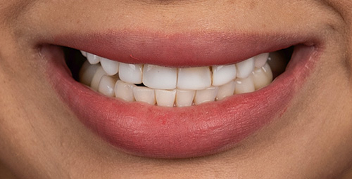 Smile Design Patient 2 Before