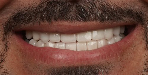 Smile Design Yosniel After