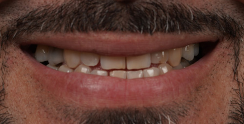 Smile Design Yosniel Before