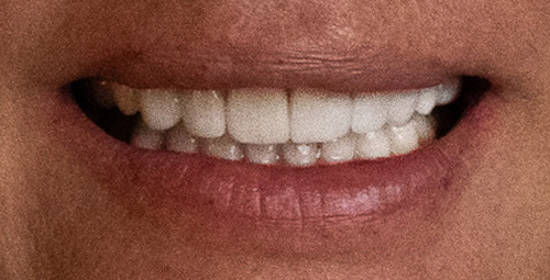 Smile Design Annemirie Castillo After