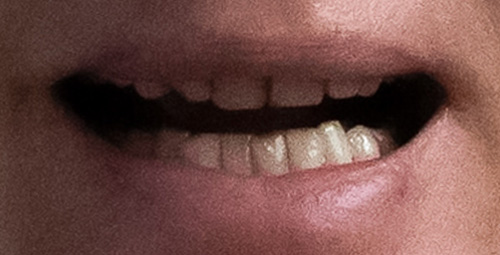 Smile Design Annemirie Castillo Before