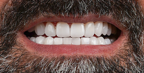 Smile Design Arian After