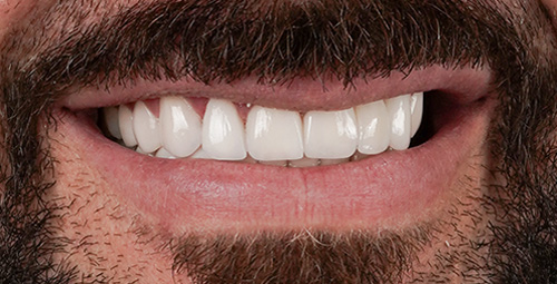 Smile Design Carlos After