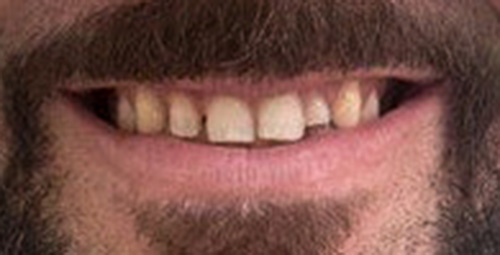 Smile Design Carlos Before