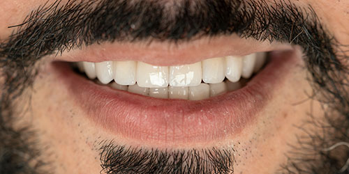 Smile Design Patient Daniel Luckert After