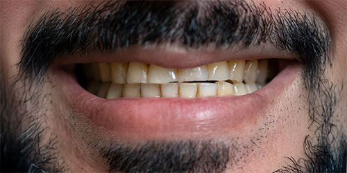 Smile Design Patient Daniel Luckert Before